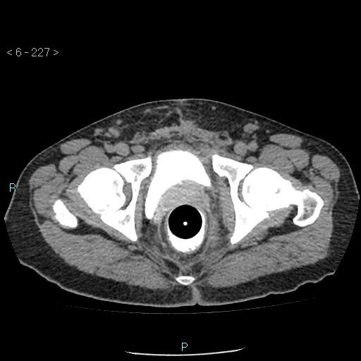 Colo-cutaneous fistula (Radiopaedia 40531-43129 A 95).jpg