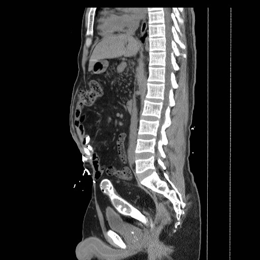 Colocutaneous fistula in Crohn's disease (Radiopaedia 29586-30093 F 14).jpg