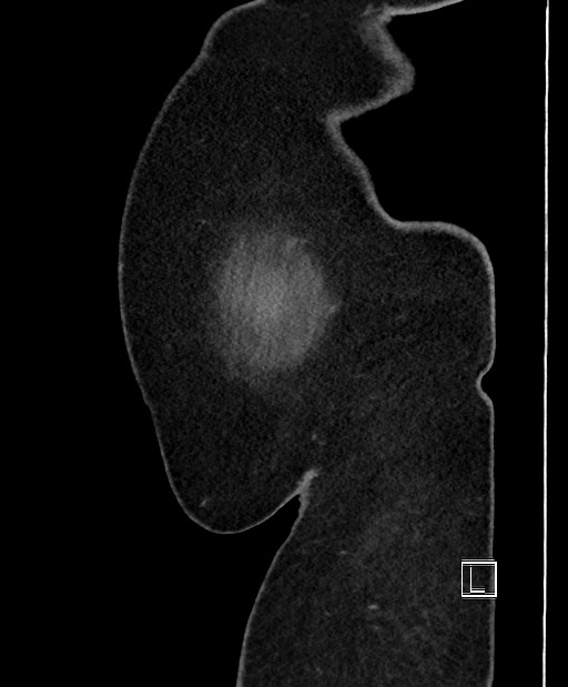 Colon adenocarcinoma (Radiopaedia 59374-66735 C 65).jpg
