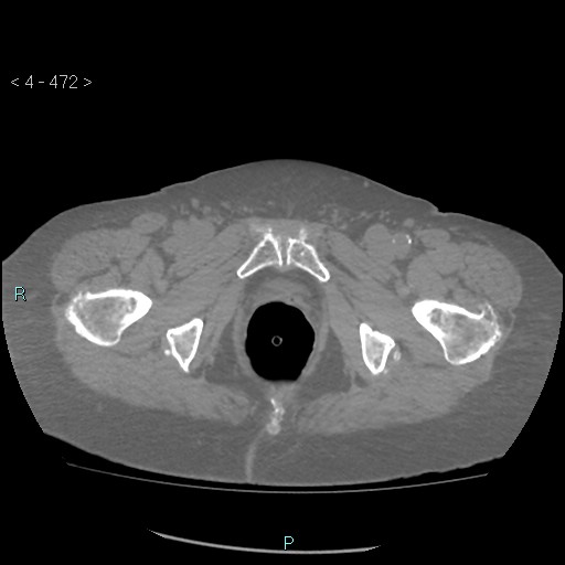 Colonic lipomas (Radiopaedia 49137-54244 Axial bone window 210).jpg