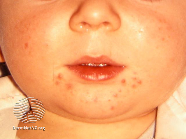 File:Infantile acne (DermNet NZ acne-infantile-acne5).jpg