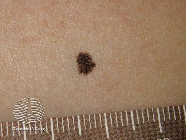File:Ink spot lentigo (DermNet NZ lesions-ink-spot05).jpg