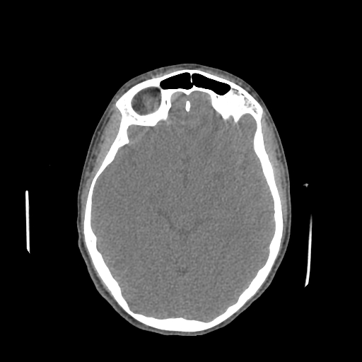 File:Nasal pyogenic granuloma (lobular capillary hemangioma) (Radiopaedia 85536-101244 Axial non-contrast 127).jpg