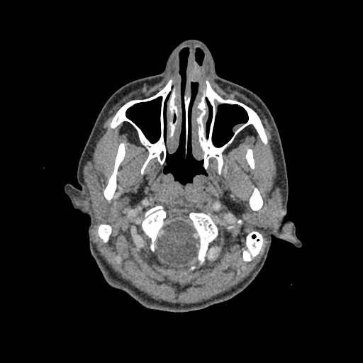 Nasal pyogenic granuloma (lobular capillary hemangioma) (Radiopaedia 85536-101244 C 33).jpg