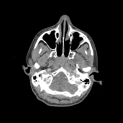 File:Nasal pyogenic granuloma (lobular capillary hemangioma) (Radiopaedia 85536-101244 C 59).jpg