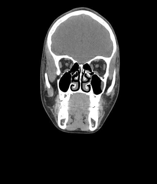 Nasal pyogenic granuloma (lobular capillary hemangioma) (Radiopaedia 85536-101244 Coronal non-contrast 88).jpg