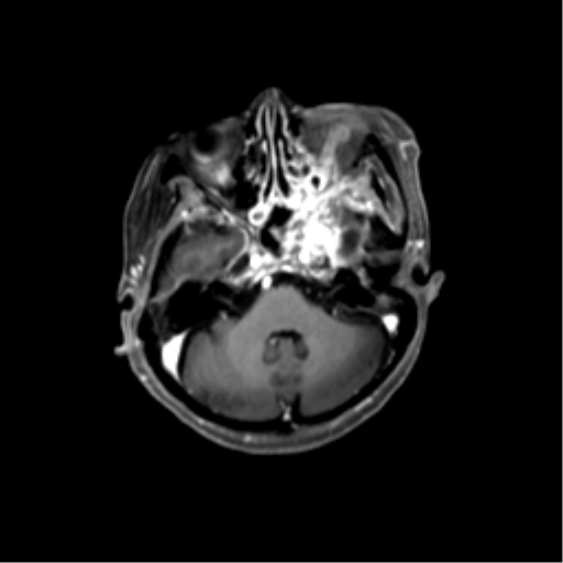File:Nasopharyngeal carcinoma with cerebral abscess (Radiopaedia 43018-46274 Axial T1 C+ fat sat 16).png