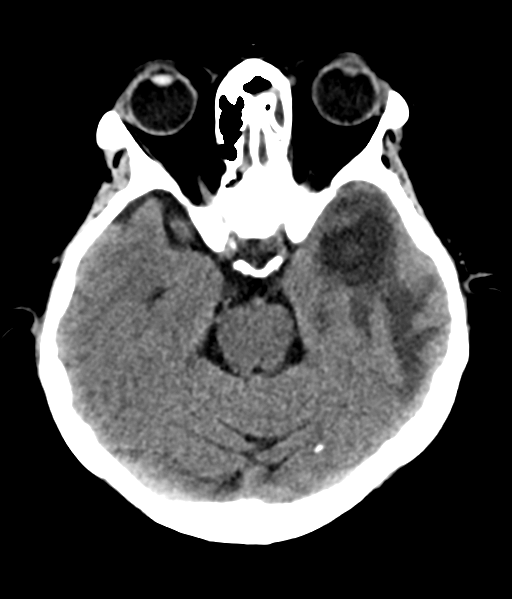 File:Nasopharyngeal carcinoma with cerebral abscess (Radiopaedia 43018-46275 Axial non-contrast 20).png