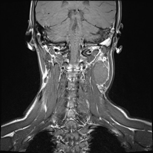 File:Nasopharyngeal carcinoma with skull base invasion (Radiopaedia 53415-59485 Coronal T1 7).jpg