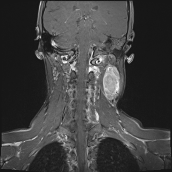 Nasopharyngeal carcinoma with skull base invasion (Radiopaedia 53415-59485 E 8).jpg