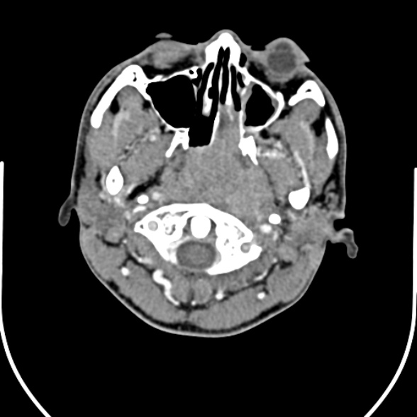 Nasopharyngeal carcinoma with skull base invasion (Radiopaedia 53415-59705 A 43).jpg