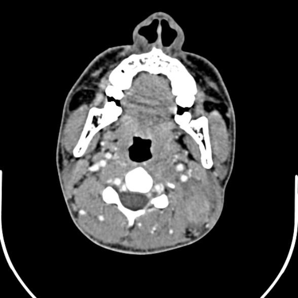 Nasopharyngeal carcinoma with skull base invasion (Radiopaedia 53415-59705 A 93).jpg