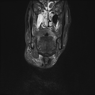 Nasopharyngeal carcinoma with skull base invasion (Radiopaedia 59258-66600 Coronal T2 fat sat 28).jpg