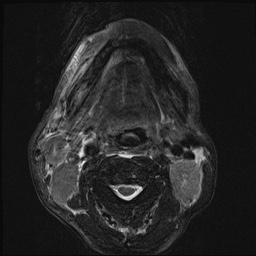 File:Nasopharyngeal carcinoma with skull base invasion (Radiopaedia 59258-66600 D 40).jpg