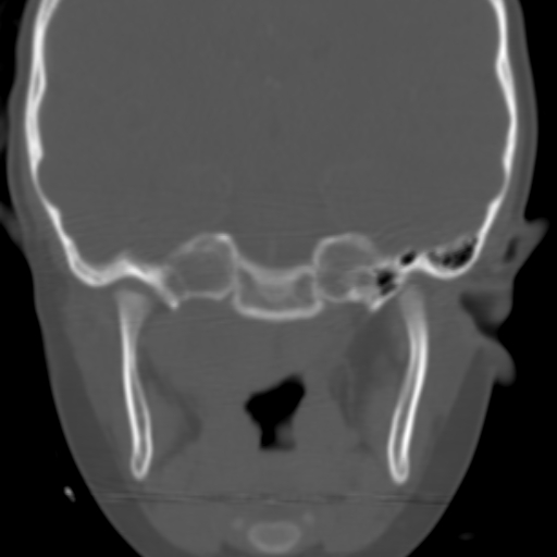 File:Nasopharyngeal rhabdomyosarcoma (Radiopaedia 23417-23491 Coronal bone window 4).jpg
