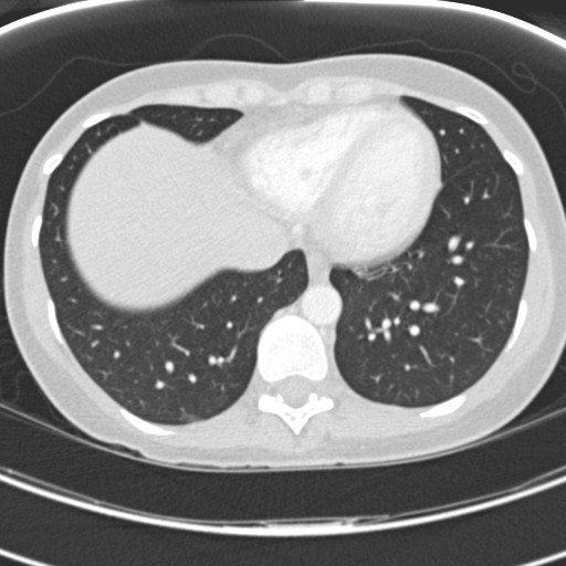 Necrobiotic pulmonary nodules - Crohn disease (Radiopaedia 20723-20631 Axial lung window 109).jpg