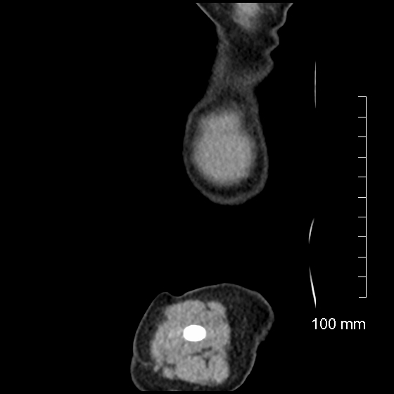 File:Neonatal neuroblastoma (Radiopaedia 56651-63438 C 11).jpg