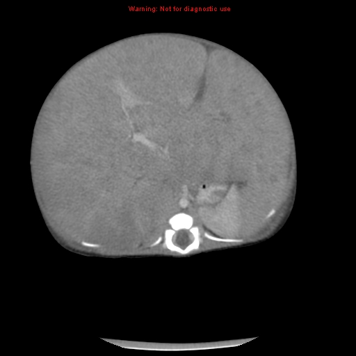 File:Neonatal neuroblastoma (Radiopaedia 9564-10223 A 23).jpg