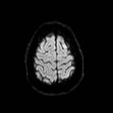 File:Neuro-Behcet's disease (Radiopaedia 21557-21506 Axial DWI 24).jpg