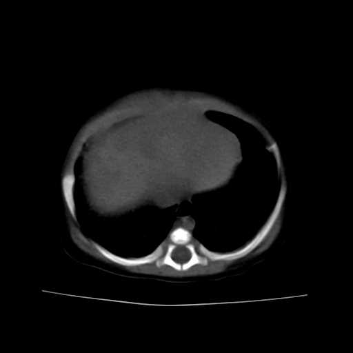 File:Neuroblastoma (Radiopaedia 20876-20799 Axial non-contrast 3).jpg