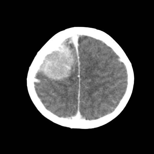 File:Neuroblastoma (Radiopaedia 8176-36438 Axial C+ delayed 2).jpg