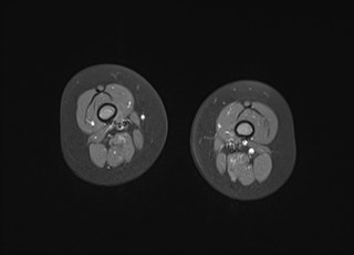 File:Neuroblastoma with bone metastases (Radiopaedia 67080-76414 Axial T1 C+ fat sat 21).jpg
