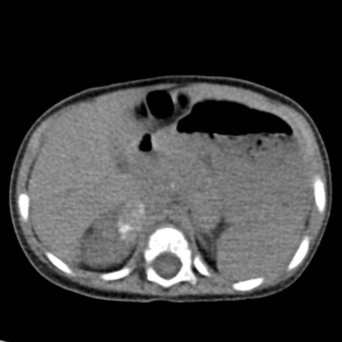 Neuroblastoma with skull metastases (Radiopaedia 30326-30960 Axial non-contrast 18).jpg
