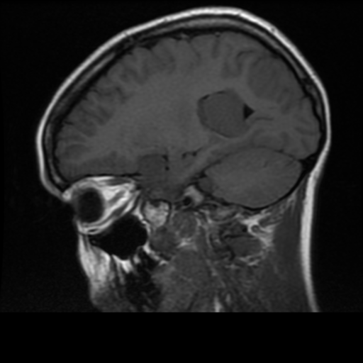 File:Neurofibromatosis type 2 (Radiopaedia 45229-49244 Sagittal T1 7).png