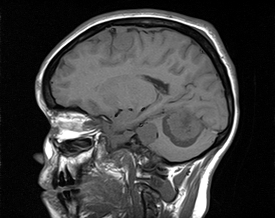 File:Neurofibromatosis type 2 (Radiopaedia 66211-75401 Sagittal T1 10).jpg