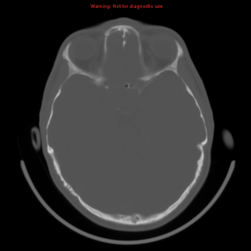 File:Neurofibromatosis type 2 (Radiopaedia 8953-9732 Axial bone window 13).jpg