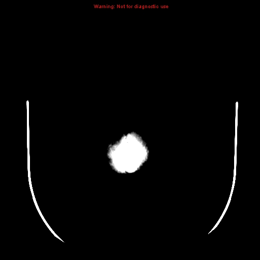 File:Neuroglial cyst (Radiopaedia 10713-11185 Axial non-contrast 1).jpg