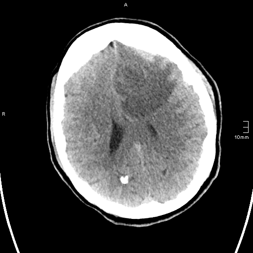 File:Neurotoxoplasmosis - concentric target sign (Radiopaedia 70644-80783 Axial non-contrast 24).jpg