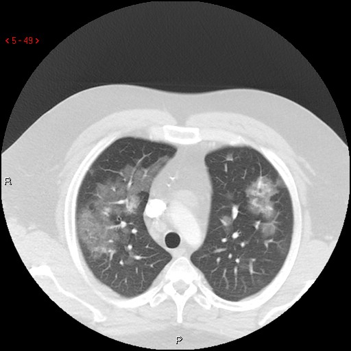 File:Non-specific interstitial pneumonitis (Radiopaedia 27044-27222 Axial lung window 40).jpg