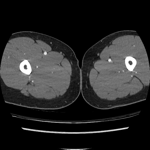 File:Normal CT angiogram of pelvis (Radiopaedia 45390-49430 A 82).jpg