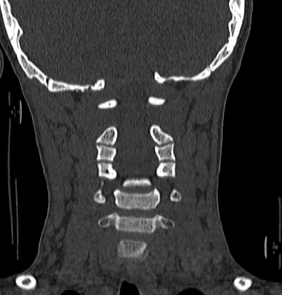 File:Normal CT cervical spine - 12-year-old (Radiopaedia 55352-61775 Coronal bone window 113).jpg