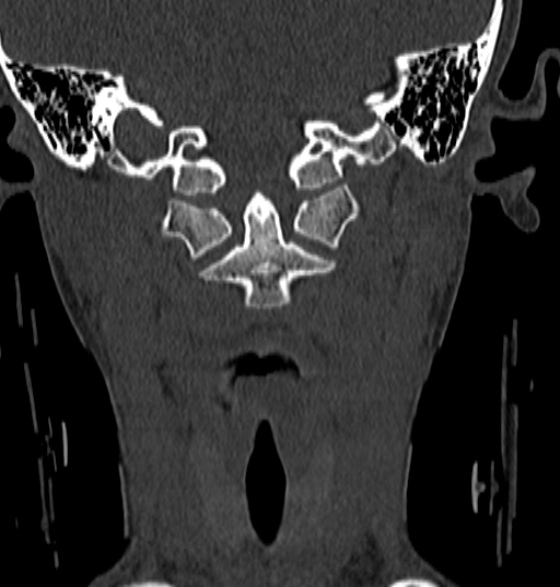File:Normal CT cervical spine - 12-year-old (Radiopaedia 55352-61775 Coronal bone window 55).jpg