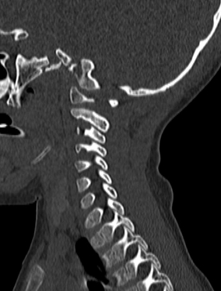 Normal CT cervical spine - pediatric (Radiopaedia 52549-58462 Sagittal bone window 56).jpg