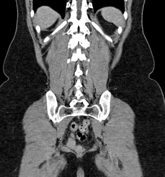 Normal CT intravenous urogram (Radiopaedia 39444-41759 A 352).jpg