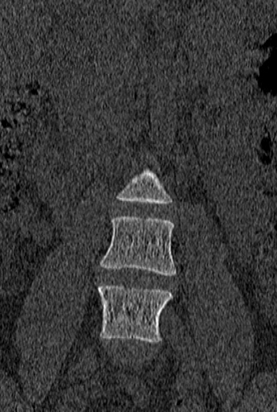 Normal CT lumbar spine (Radiopaedia 53981-60118 Coronal bone window 8).jpg