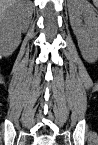 Normal CT lumbar spine (Radiopaedia 53981-60118 F 71).jpg