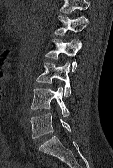 File:Normal CT lumbar spine (Radiopaedia 53981-60118 Sagittal bone window 37).jpg