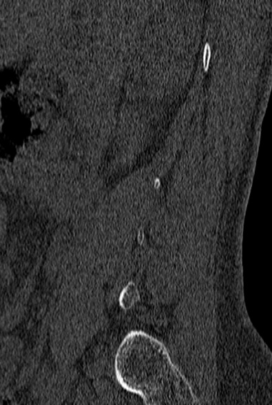 File:Normal CT lumbar spine (Radiopaedia 53981-60118 Sagittal bone window 7).jpg