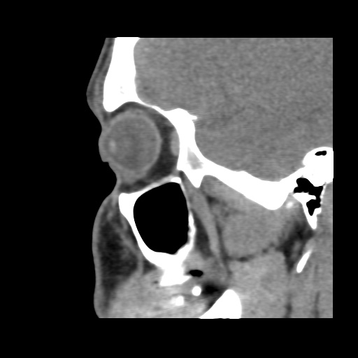 Normal CT paranasal sinuses (Radiopaedia 42286-45390 F 111).jpg
