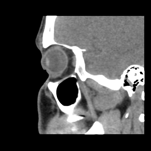 Normal CT paranasal sinuses (Radiopaedia 42286-45390 F 44).jpg