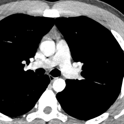 File:Normal CT pulmonary veins (pre RF ablation) (Radiopaedia 41748-44702 A 59).png