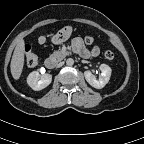 File:Normal CT split bolus study of the renal tract (Radiopaedia 48631-53634 Axial split bolus 75).jpg