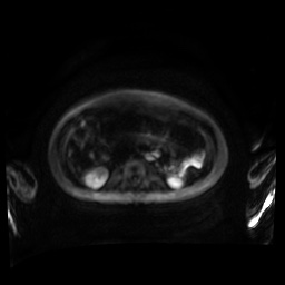 Normal MRI abdomen in pregnancy (Radiopaedia 88001-104541 Axial DWI 71).jpg