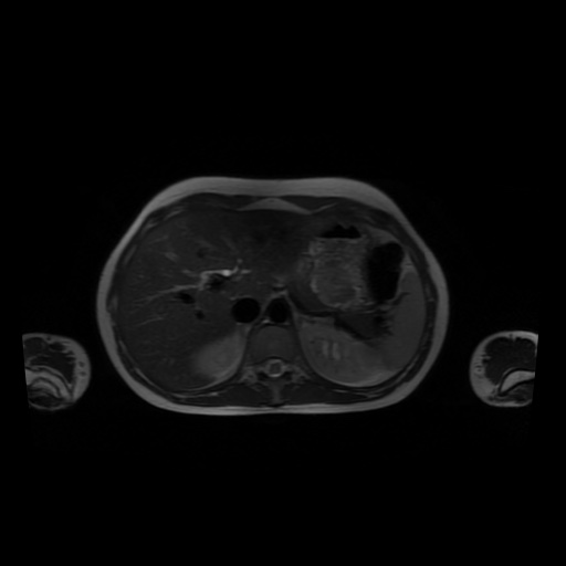 File:Normal MRI abdomen in pregnancy (Radiopaedia 88001-104541 Axial T2 13).jpg