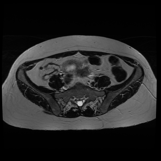 Normal MRI abdomen in pregnancy (Radiopaedia 88005-104548 Axial T2 17).jpg
