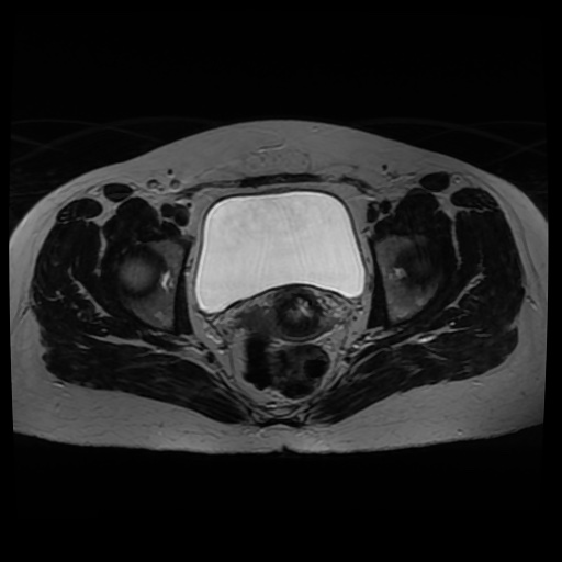 Normal MRI abdomen in pregnancy (Radiopaedia 88005-104548 Axial T2 36).jpg
